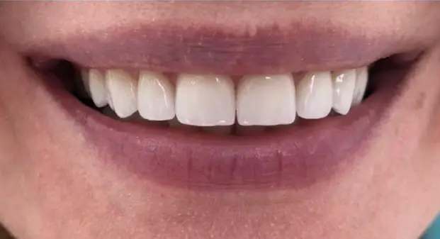 smile-makeover-before-and-after-UAE