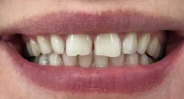 smile-makeover-before-and-after-UAE