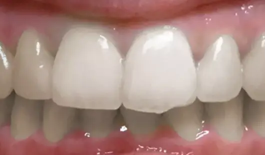 spark-clear-aligners-before-and-after-pictures