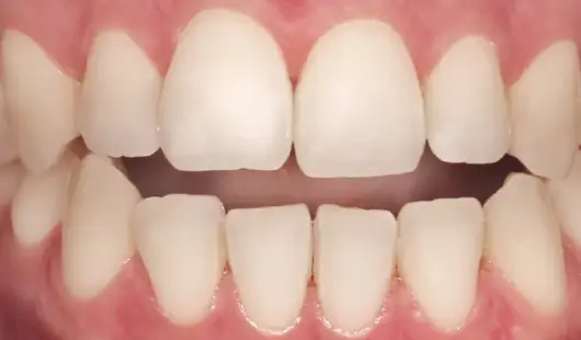 spark-clear-aligners-price-in-dubai