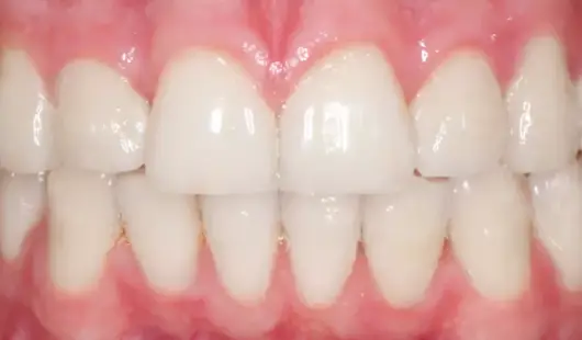 spark-clear-aligners-resullts-dubai