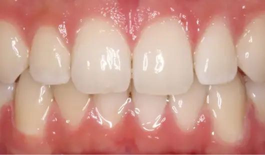 spark-clear-aligners-treatment-images-dubai