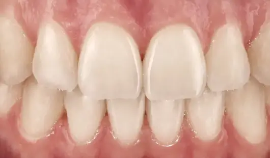 spark-clear-aligners-treatment-price-in-UAE