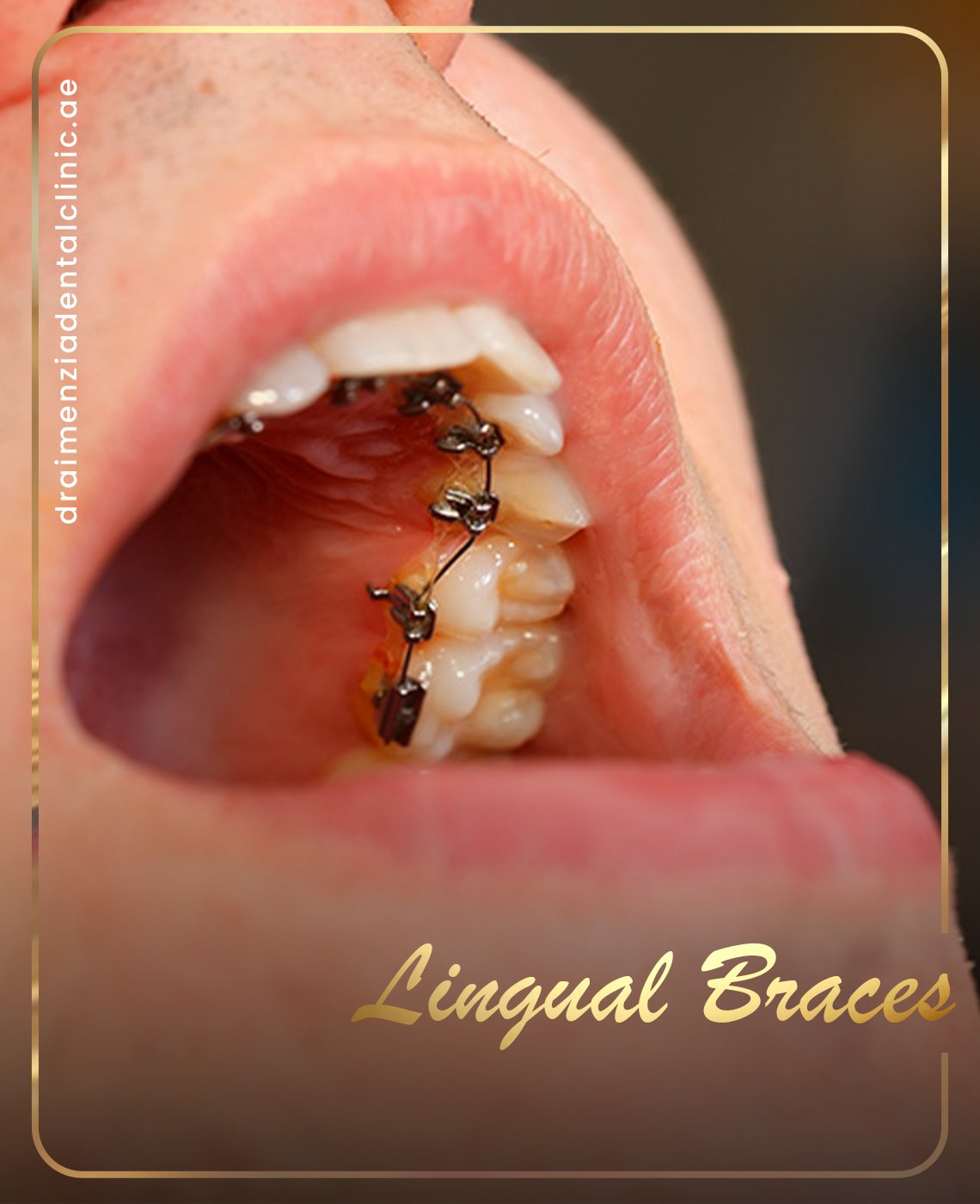 teeth-straightening-dubai