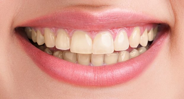 teeth-whitening-before-and-after-dubai