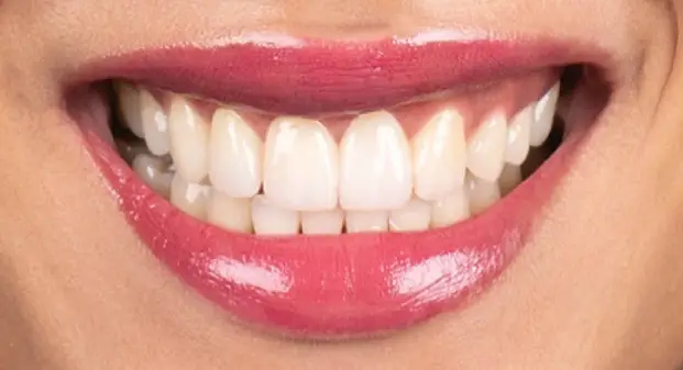 veneers-and-smile-makeover-dubai