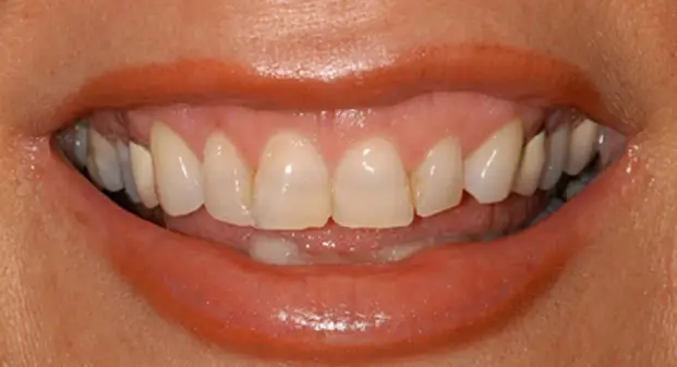 veneers-before-and-after-dubai