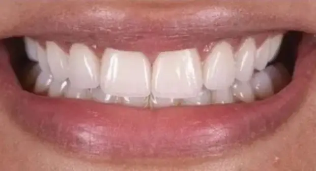 veneers-before-and-after-dubai