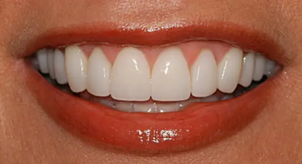 veneers-before-and-after-dubai