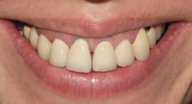 veneers-before-and-after-results-dubai