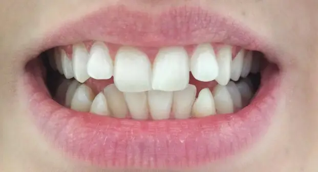 veneers-consultation-dubai