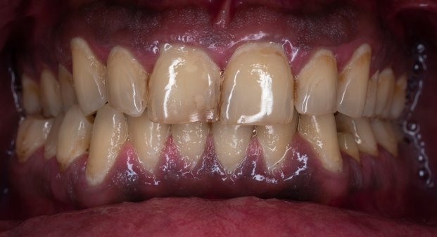 zoom-professional-whitening-dubai