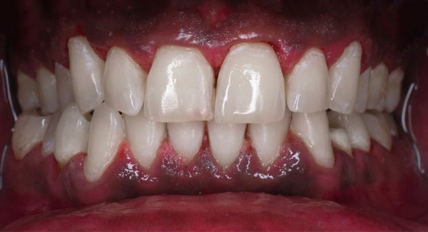 zoom-professional-whitening-UAE