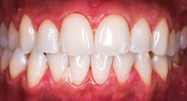 zoom-whitening-before-and-after-near-me