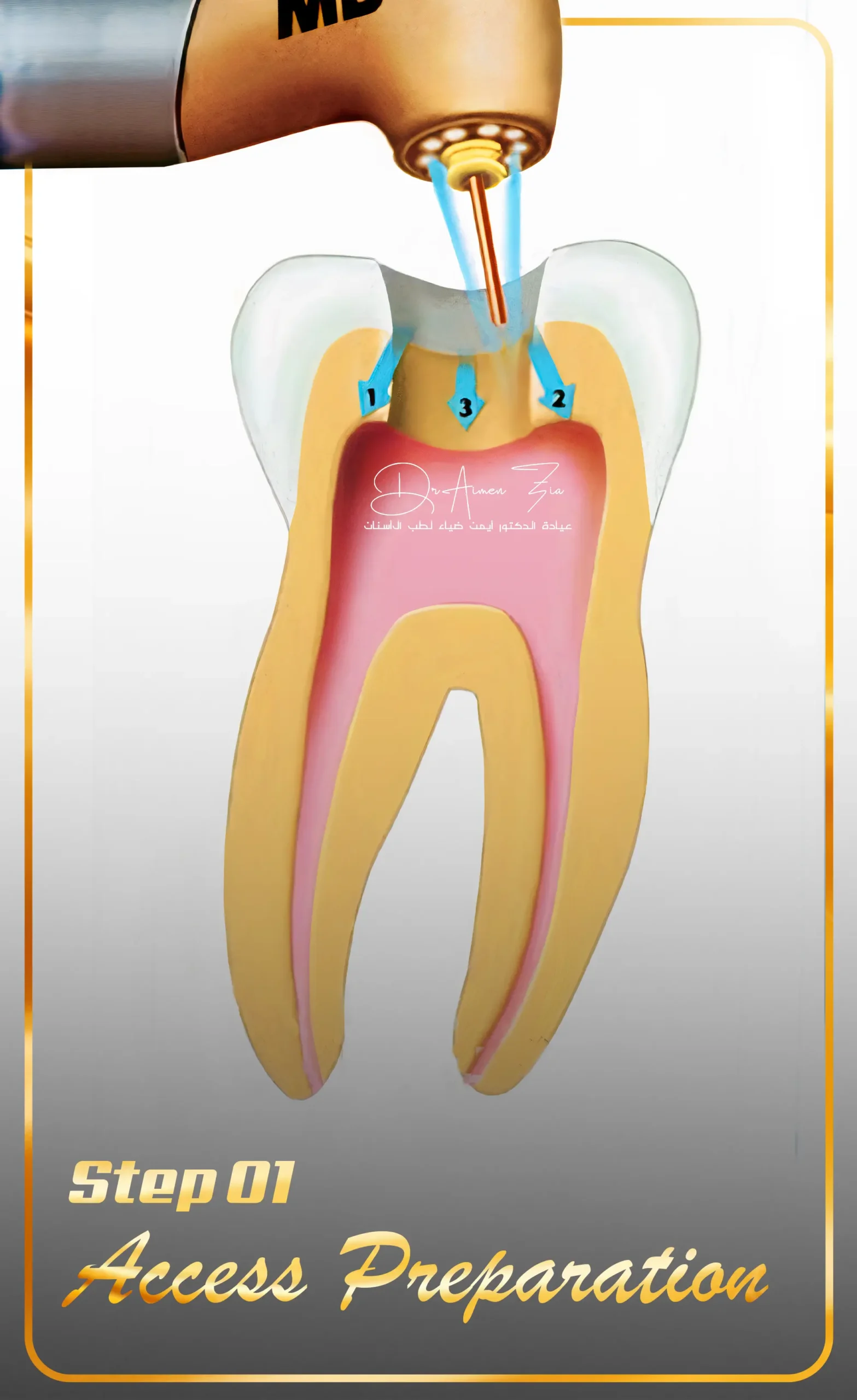 advanced-laser-root-canal-treatment-in-dubai