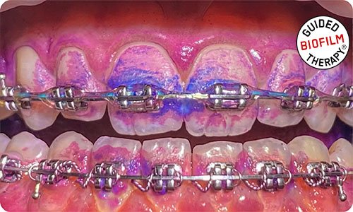 airflow-guided-biofilm-therapy-in-dubai