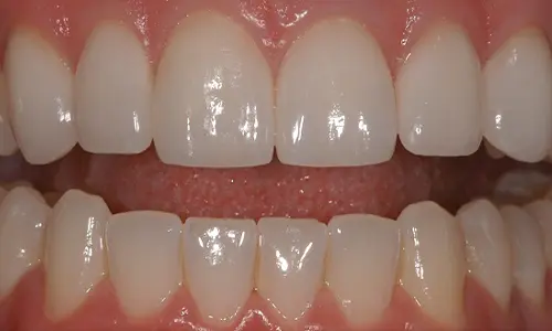 align-bleach-and-bond-treatment-in-dubai