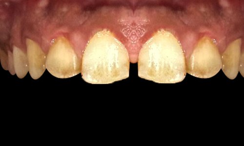 before-after-composite-veneers