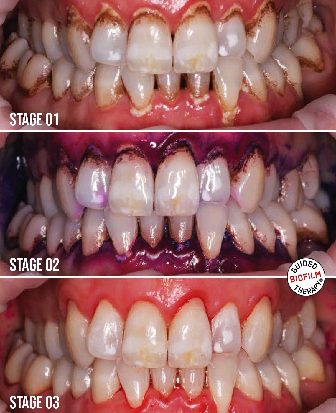 before-and-after-of-GBT-guided-biofilm-therapy-cleaning-in-dubai