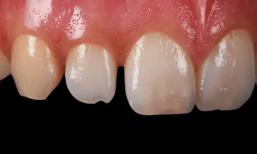 best-before-and-after-results-of-composite-veneers-in-dubai