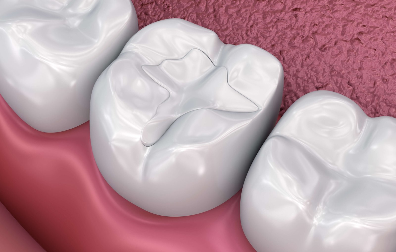 best-dental-clinic-for-composite-fillings-cost-in-dubai