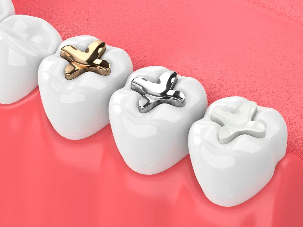 best-dental-clinic-for-silver-gold-and-amalgam-fillings-in-dubai