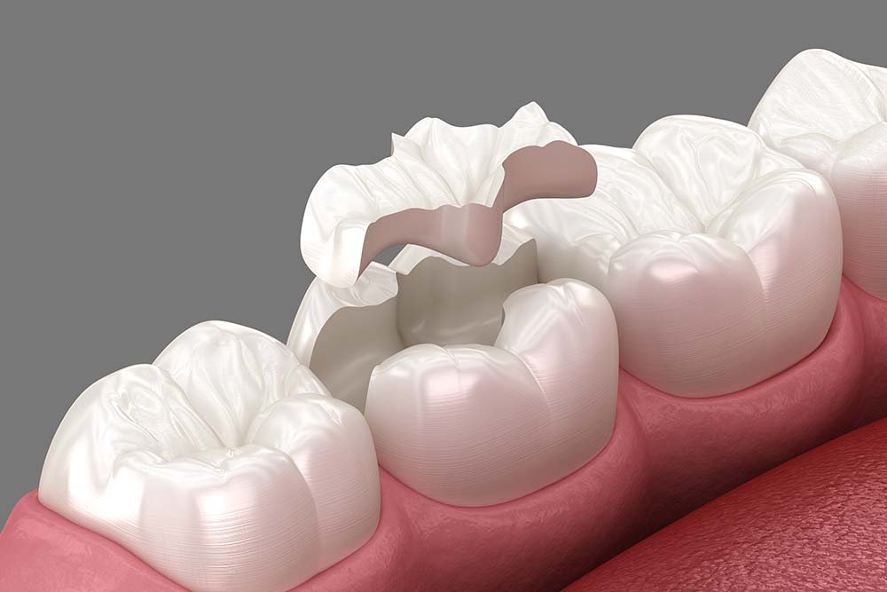 best-dentist-for-ceramic-porcelain-fillings-in-dubai