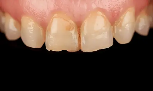 best-dentist-for-composite-veneers-dubai