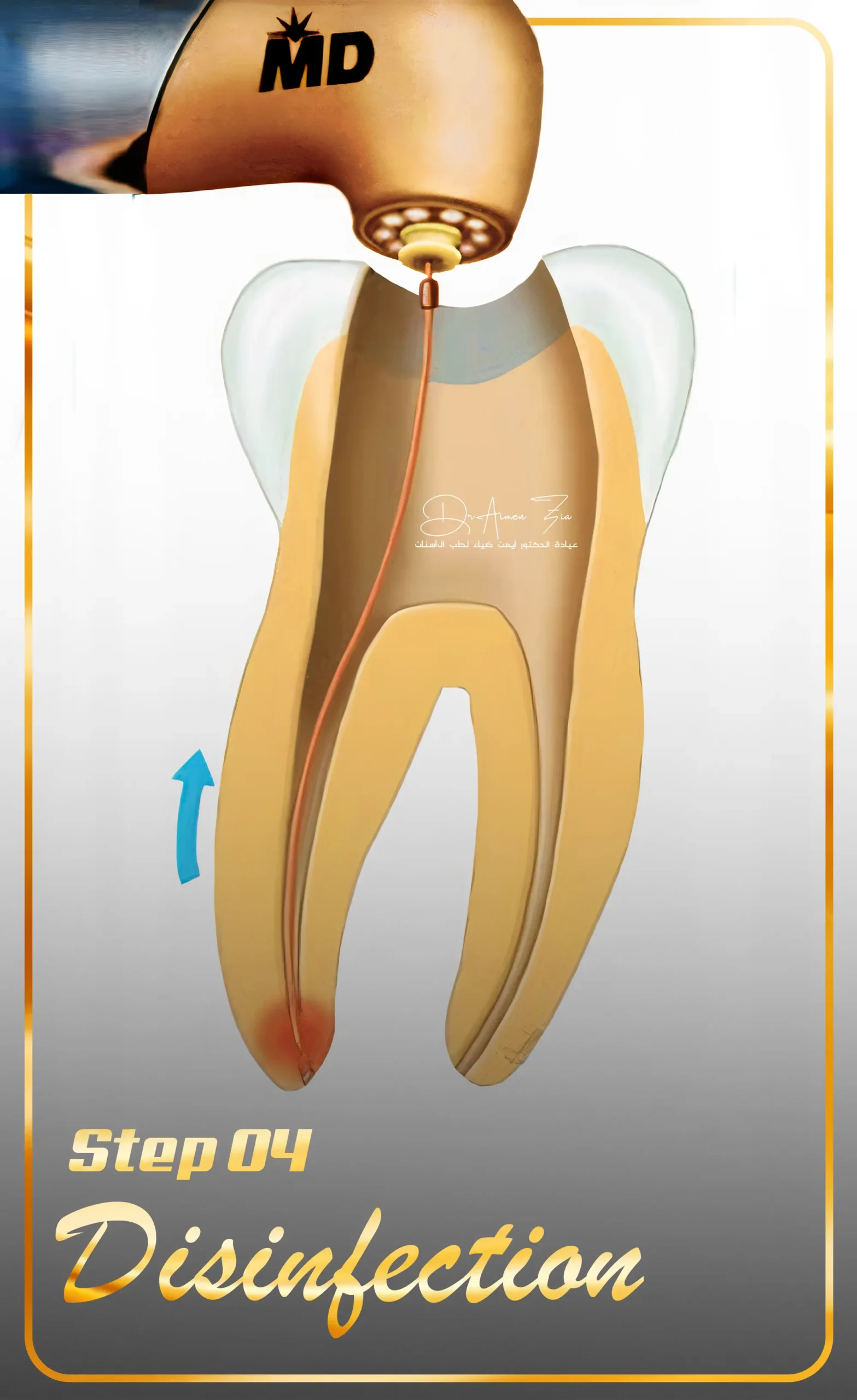 best-endodontist-for-laser-root-canal-treatment-in-dubai