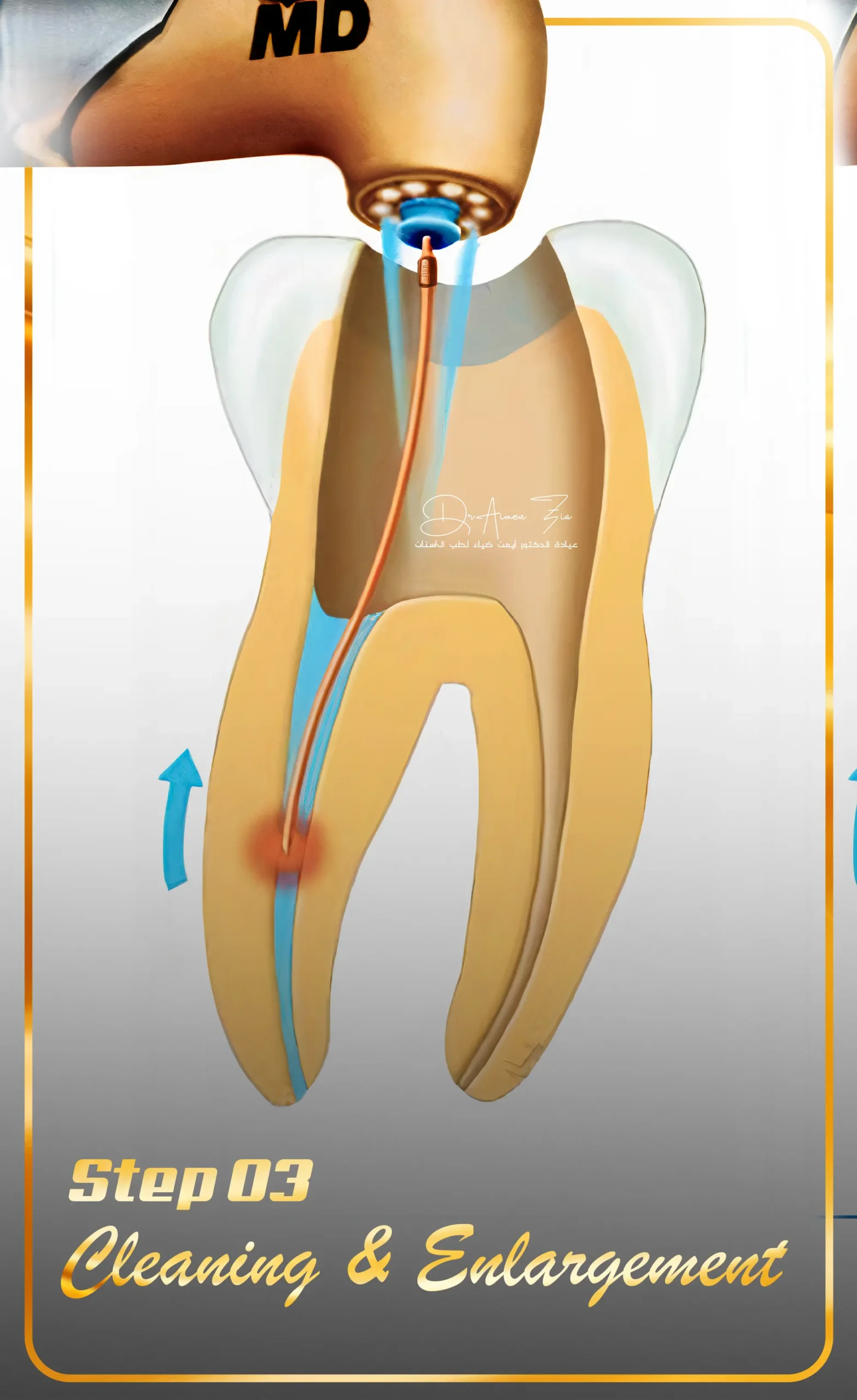 best-female-dentist-for-laser-root-canal-treatment-in-dubai