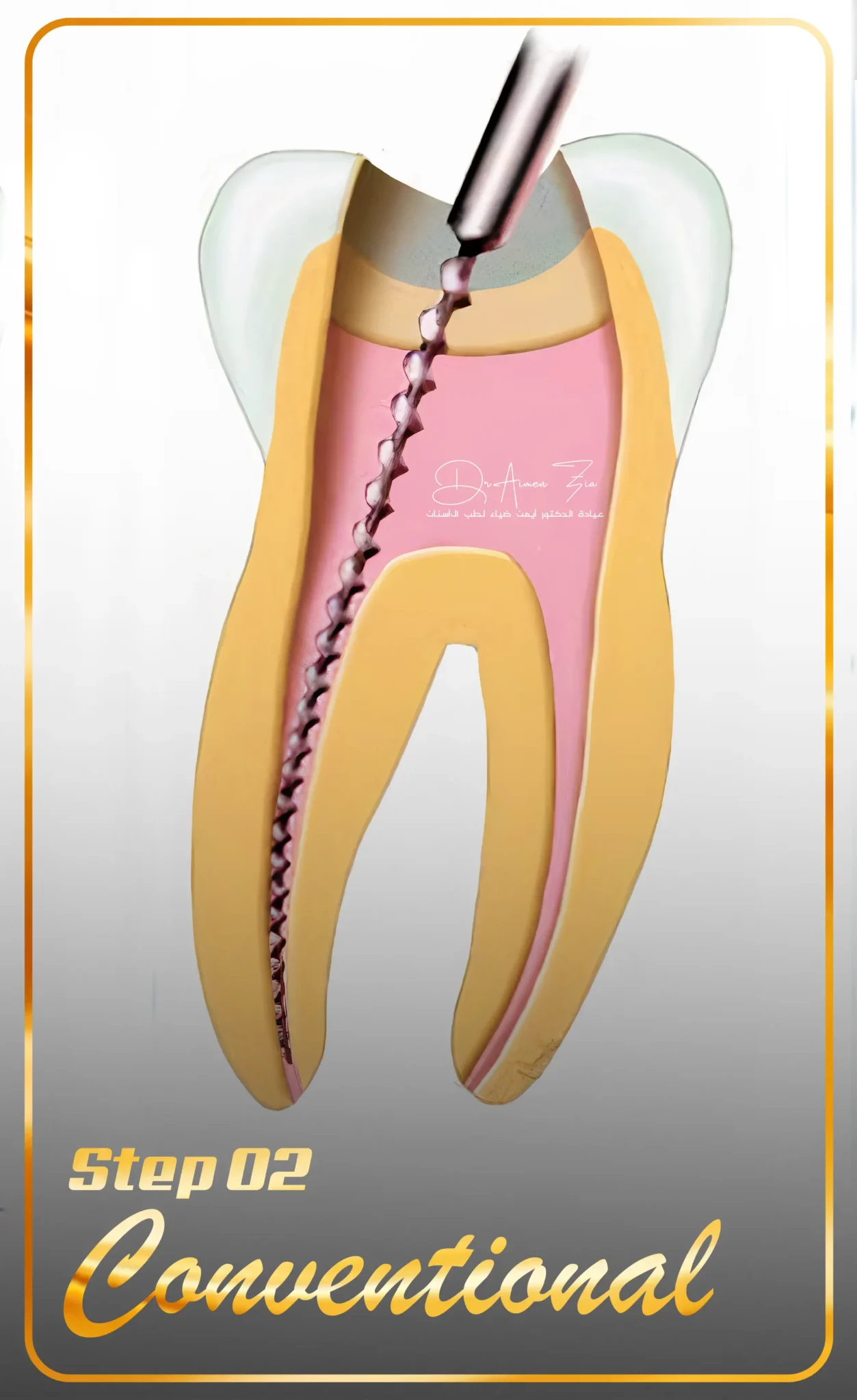 best-senior-dentist-for-laser-root-canal-treatment-in-dubai