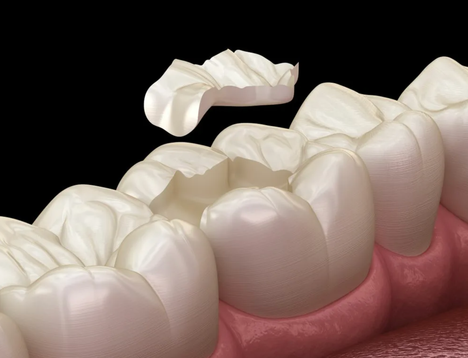 ceramic-porcelain-fillings-in-UAE
