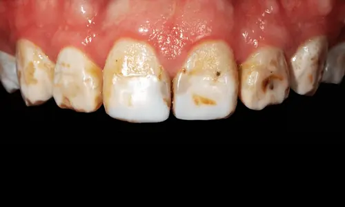 composite-veneers-for-chipped-tooth-dubai