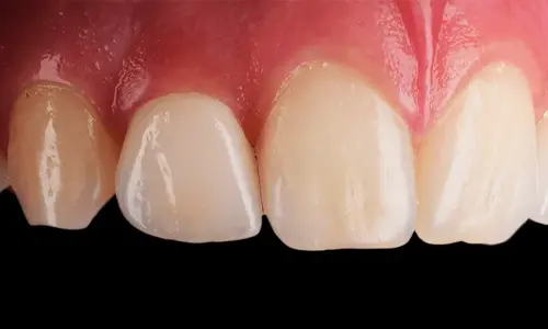 composite-veneers-treatment-in-dubai