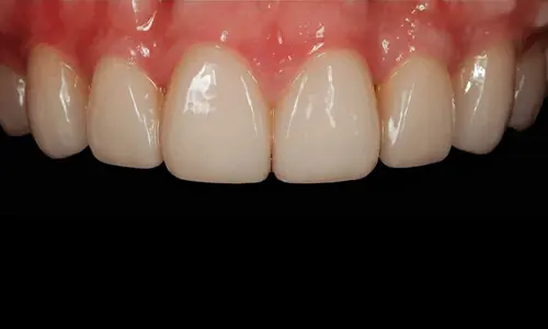 cosmetic-composite-veneers-in-dubai