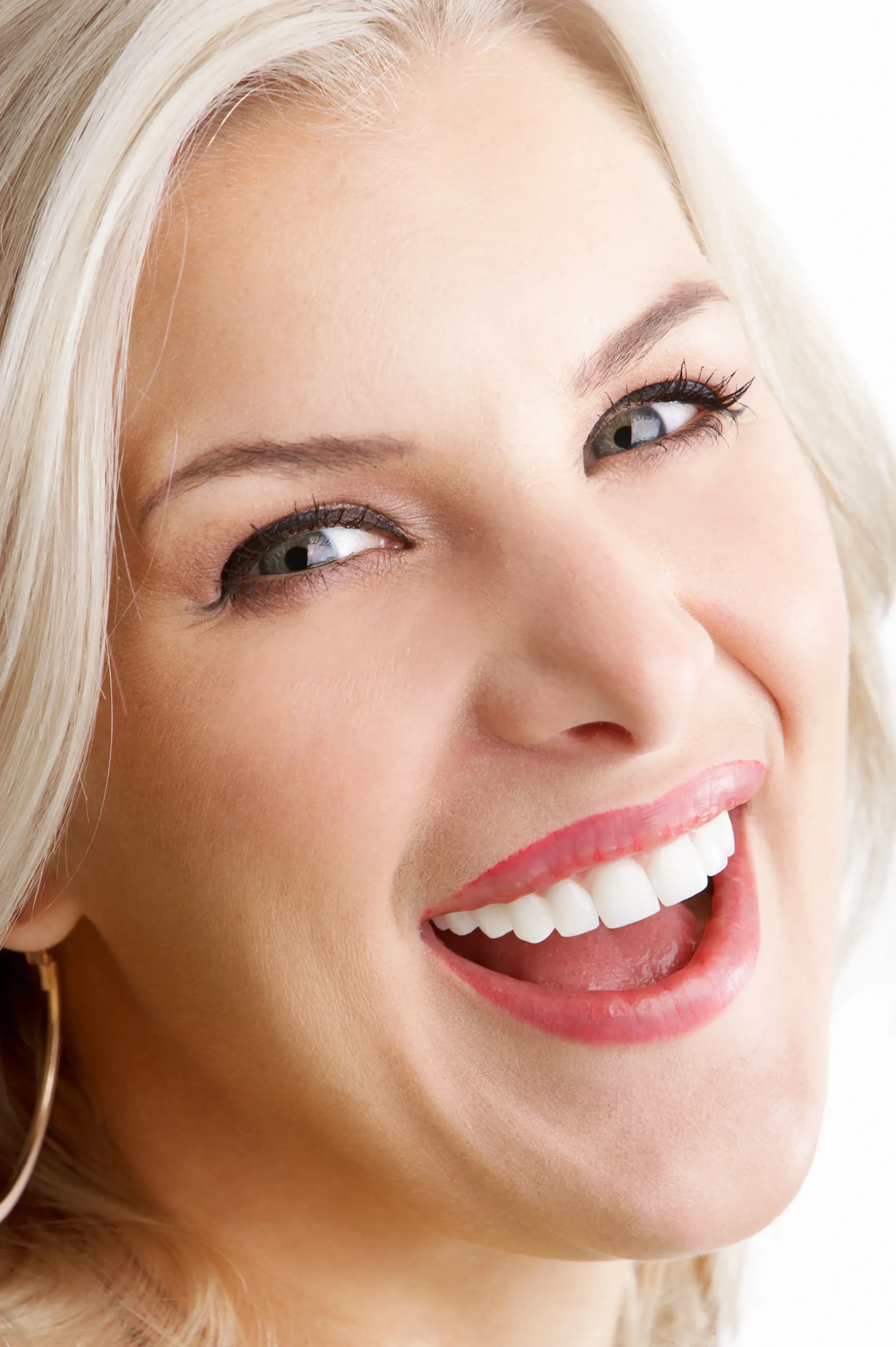 dental-veneers-in-dubai