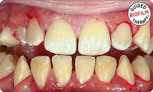 guided-biofilm-therapy-cleaning-cost-in-dubai