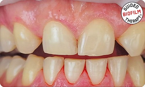 guided-biofilm-therapy-clinic-dubai