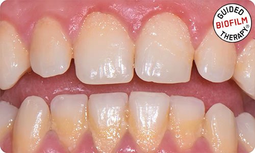 guided-biofilm-therapy-dubai