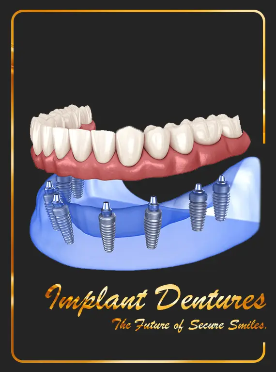 implant-supported-dentures-in-dubai