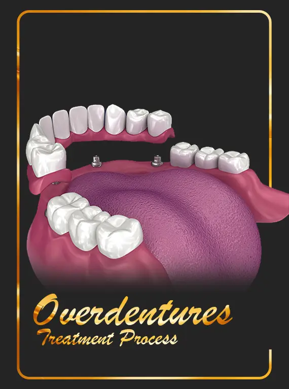 overdentures-in-dubai