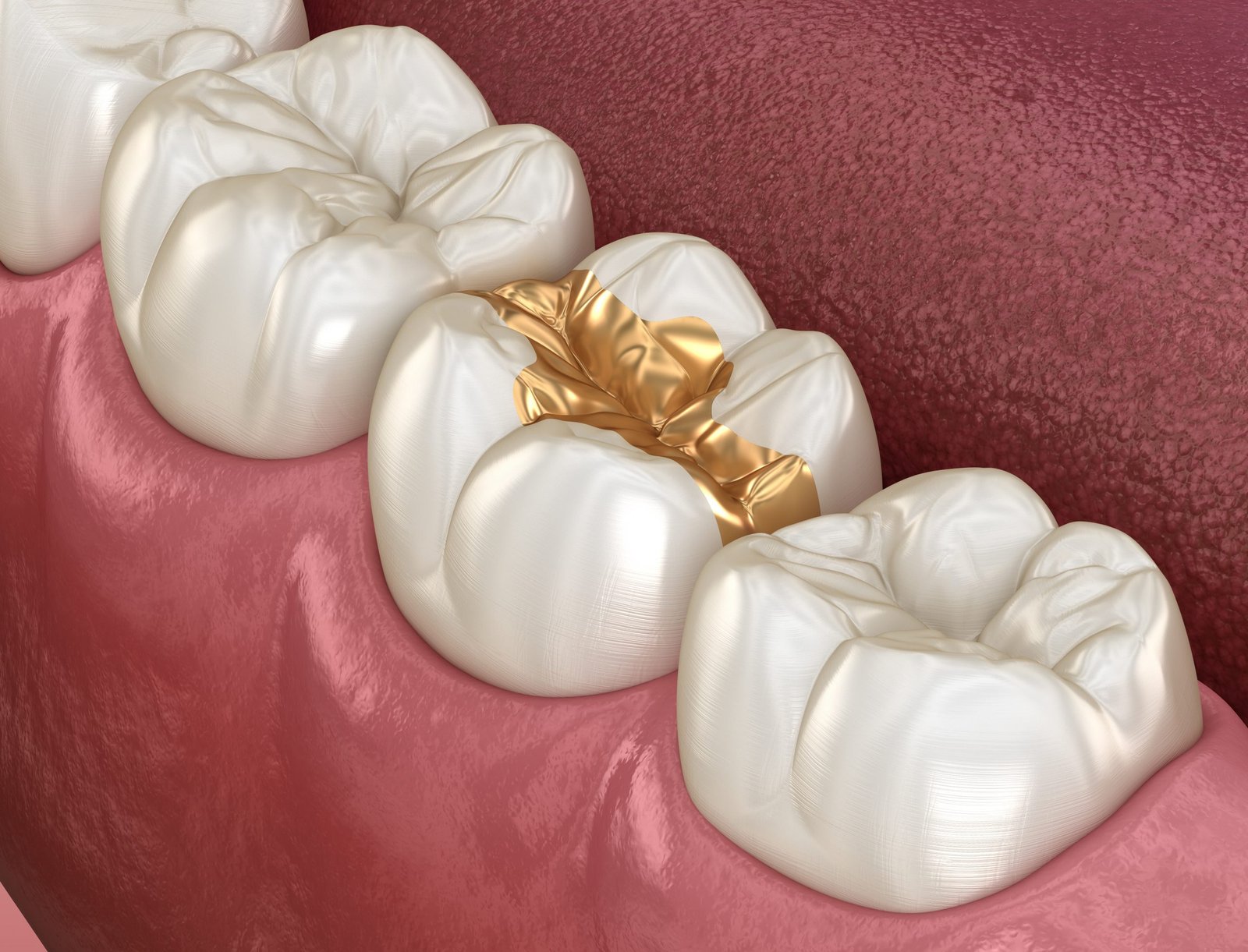 premium-gold-tooth-filling-in-dubai