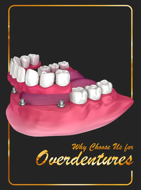 removable-overdentures-in-dubai