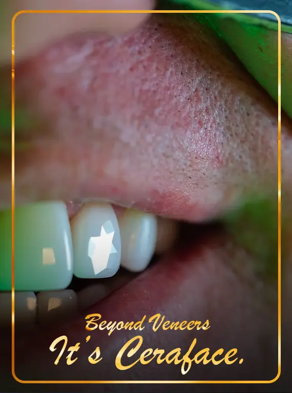 best-dental-clinic-for-ceraface-veneers-cost-in-dubai