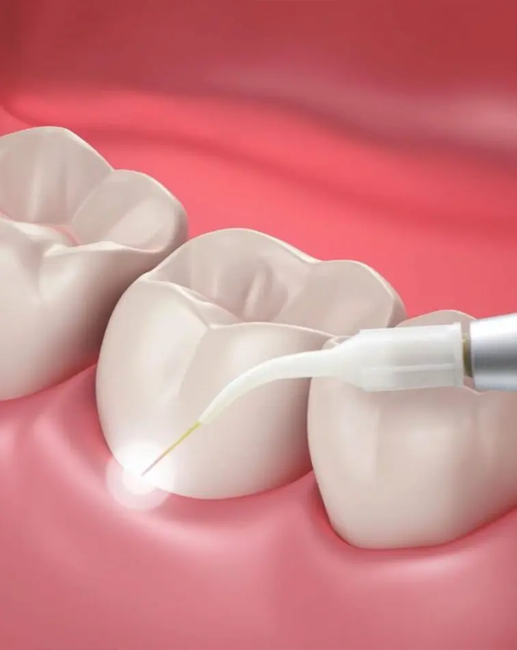 laser-assisted-periodontal-treatments-in-dubai