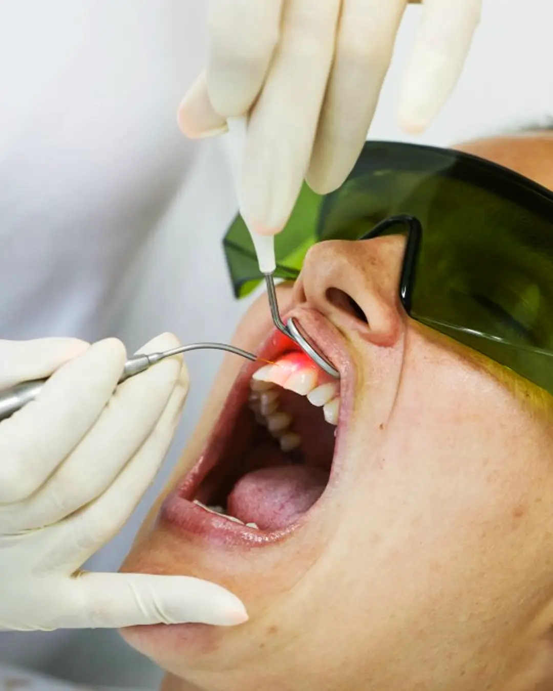 Laser-Lesion-Removal-in-Dubai